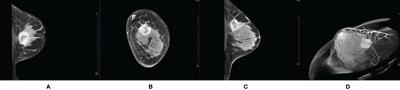 Contrast-Enhanced Cone-Beam Breast CT: An Analysis of Diagnostic Value in Predicting Breast Lesion With Rim Enhancement Malignancy